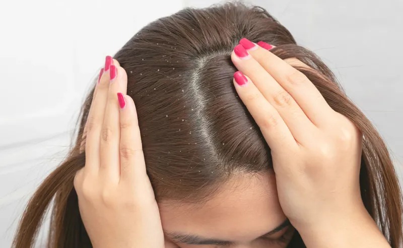 सर में जमी Dandruff को निकाल देगा ये तेल, कपूर के साथ मिलाकर लगा ले केवल ये 2 चीज..