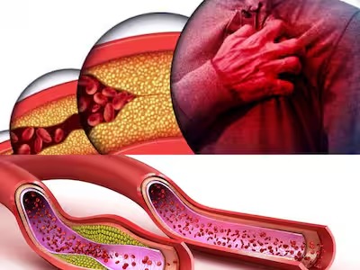 Cholesterol बढ़ने पर शरीर में दिखाई देते हैं ये 5 शुरुआती संकेत,